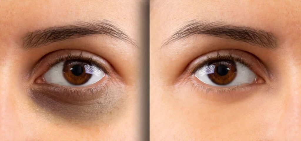 Dark Circles