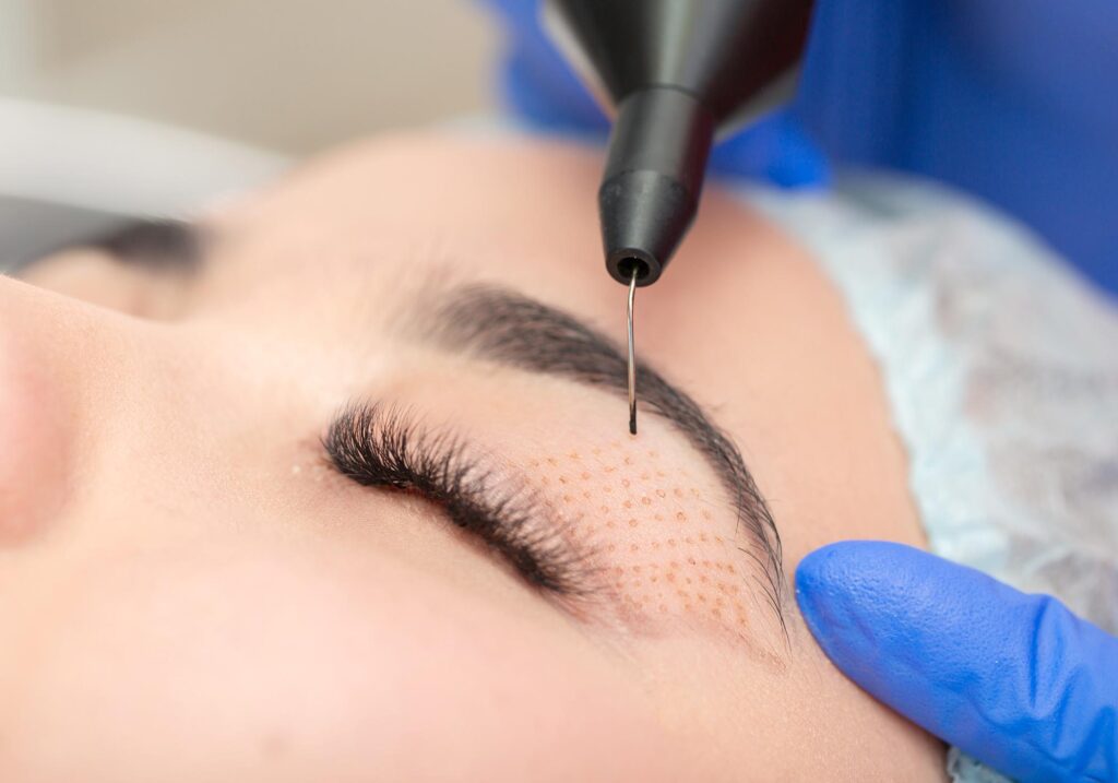 Eyelid Release